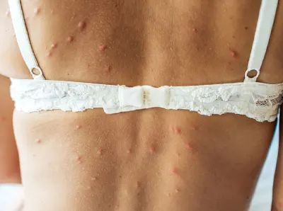 Alignement de piqûres de punaises de lit sur un avant-bras